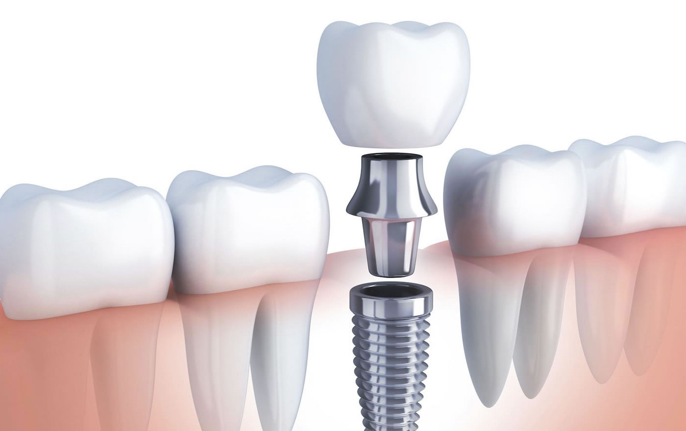 Implante y corona dental