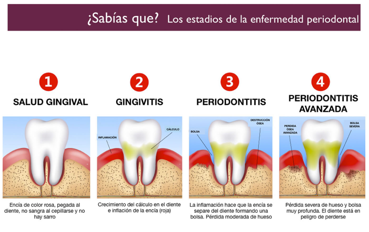 Piorrea gingivitis periodontitis
