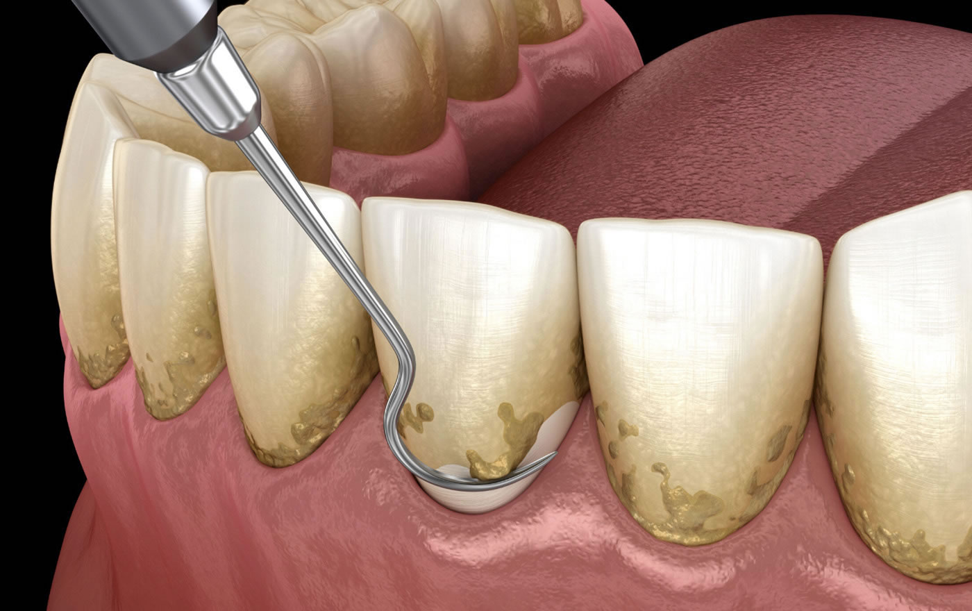 Tratamiento periodontal curetajes raspado