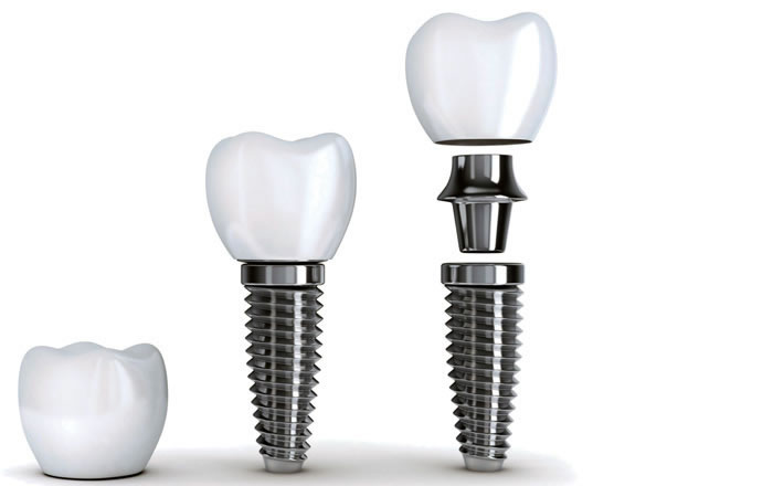Implante dental precio
