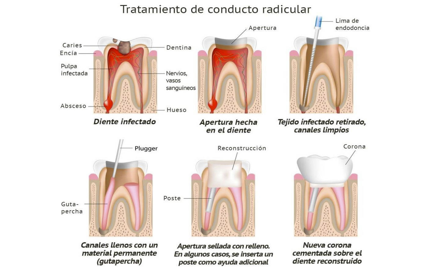 endodoncia dental en siloe