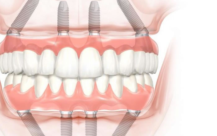 Implantes dentales siloe